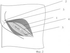 Способ обезболивания после грыжесечения паховым доступом при паховых грыжах (патент 2521836)