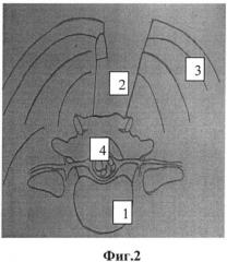 Способ реконструкции позвоночного канала при лечении стеноза пояснично-крестцового отдела позвоночника (патент 2531927)