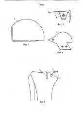 Эндопротез коленного сустава (патент 1757661)