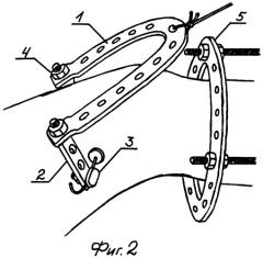 Устройство для оптимизации лечения односторонних переломов длинных костей нижних конечностей (патент 2275879)