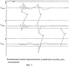 Устройство измерения артериального давления в условиях двигательной активности человека (патент 2432897)