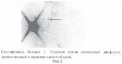 Способ индивидуальной предлучевой подготовки больных раком молочной железы (патент 2377020)