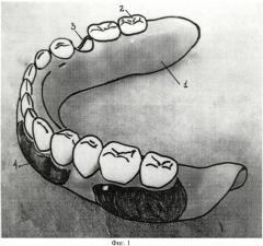 Частичный съемный протез на нижнюю челюсть (патент 2388429)