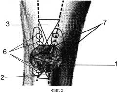 Малоинвазивный способ хирургического лечения подкожного разрыва ахиллова сухожилия (патент 2554227)