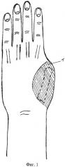 Способ реконструкции пальца при наличии дефекта мягких тканей кисти (патент 2479260)