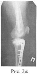 Способ хирургического лечения множественных переломов длинных костей нижних конечностей (патент 2414183)