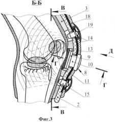 Устройство для термо- и фотохромо-ультразвукового лечения остеоартрозов (патент 2496537)