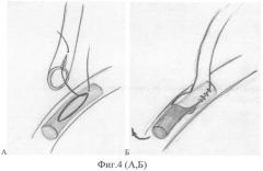 Способ лечения церебральной ишемии (патент 2408300)