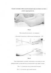 Способ лечения сгибательной контрактуры коленного сустава у детей с артрогрипозом (патент 2596726)