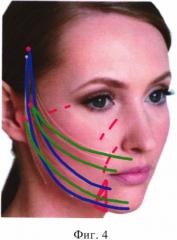 Малоинвазивный способ фиксации связок поверхностной мышечно-апоневротической системы лица (патент 2613786)