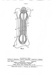 Устройство для компрессионного остеосинтеза отломков трубчатых костей (патент 1109142)