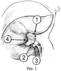 Способ анатомической резекции iv, v, viii сегментов печени (патент 2444311)