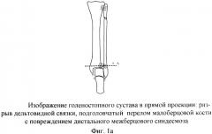 Способ оперативного лечения подголовчатых переломов малоберцовой кости при переломовывихах в голеностопном суставе (патент 2369341)