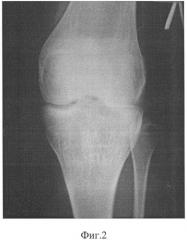 Способ внесуставной коррекции деформаций коленного сустава (патент 2316281)