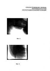 Способ проведения рентгенконтрастной уретрографии в боковой проекции (патент 2592683)