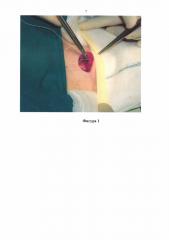 Защитный обклад для операционной раны (патент 2638435)