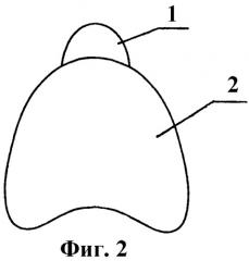 Индивидуальная ложка куретовых для снятия оттиска на беззубую челюсть (два варианта) (патент 2481804)