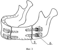 Имплантат для замещения дефектов нижней челюсти (патент 2469682)