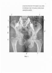 Способ реконструкции таза при сложных посттравматических деформациях (патент 2637283)