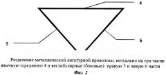 Способ шинирования зубов при пародонтите (патент 2436540)