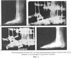 Способ лечения гипоплазии костей голени и стопы, сопровождающейся антекурвационной деформацией дистального отдела большеберцовой кости (патент 2296522)