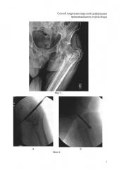 Способ коррекции варусной деформации проксимального отдела бедра (патент 2598759)