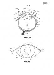 Глазное вкладочное устройство и способы (патент 2618194)