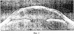 Способ измерения радиуса кривизны роговицы глаза (патент 2457774)