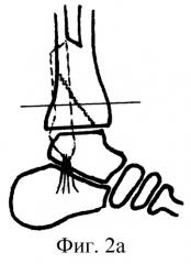 Способ артродеза голеностопного сустава при неправильно сросшихся переломах малоберцовой кости и заднего края большеберцовой кости (патент 2243737)
