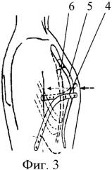 Способ лечения врожденной килевидной деформации грудной клетки в сочетании с ладьевидной деформацией реберных дуг (патент 2373879)