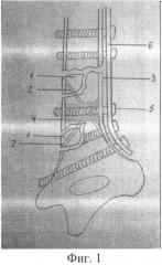 Способ лечения оскольчатых переломов трубчатых костей (патент 2424777)