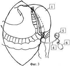 Устройство для фиксации селезенки в операционной ране (патент 2253388)