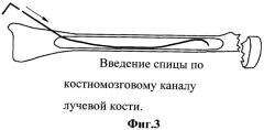 Способ лечения переломов шейки лучевой кости (патент 2342092)