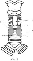 Способ этапного хирургического лечения протяженных и/или мультифокальных стенозов гортани и/или трахеи (патент 2511661)
