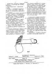 Устройство для лечения импотенции (патент 1174035)