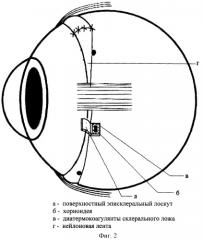 Способ лечения регматогенной отслойки сетчатки (патент 2253421)