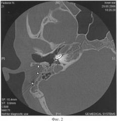 Способ формирования просвета улитки при ее частичной облитерации и установки электродной решетки кохлеарного импланта (патент 2382610)