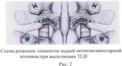 Способ реконструкции поясничного позвоночно-двигательного сегмента (патент 2527150)