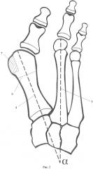 Способ коррекции оси 1 плюсневой кости при лечении hallux valgus (патент 2578543)