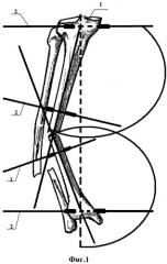 Способ лечения осевых деформаций диафиза костей голени (патент 2446760)