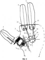 Кистевой протез (патент 2387412)