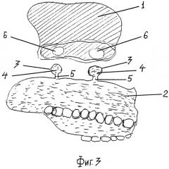 Резекционный съемный протез верхней челюсти (патент 2283064)