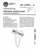 Фиксатор для остеосинтеза шейки бедренной кости (патент 1156674)