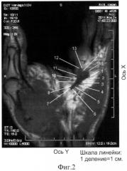 Способ идентификации границ поражения ладонного апоневроза при контрактуре дюпюитрена (патент 2553923)