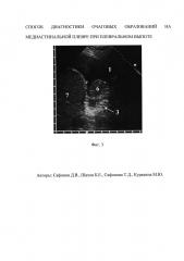 Способ дифференциальной диагностики очаговых образований на медиастинальной плевре при плевральном выпоте (патент 2626685)