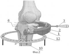 Устройство для остеотомии большеберцовой кости (патент 2340296)