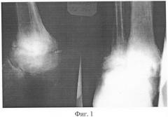 Способ артродеза при деструктивных поражениях голеностопного сустава (патент 2392892)
