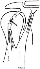 Способ оперативного лечения нестабильности плечевого сустава (патент 2412666)