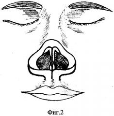 Способ пластики перегородки носа (патент 2302212)