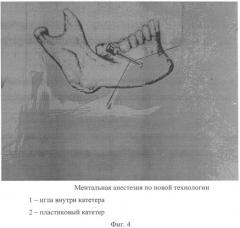 Способ проводниковой анестезии (патент 2426563)